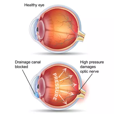 GLAUCOMA SURGERY