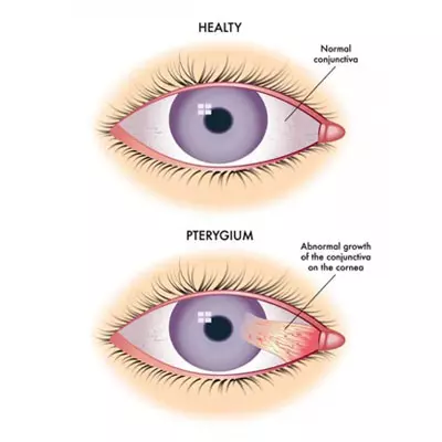 PTERYIGIUM SURGERY